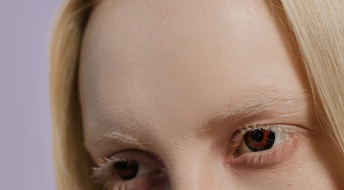 Albino Sisters Go Viral for Their Striking Beauty